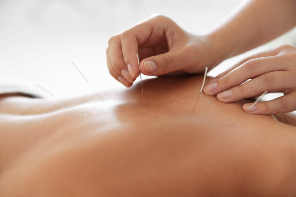 Acupuncture at Pleasant Wellness